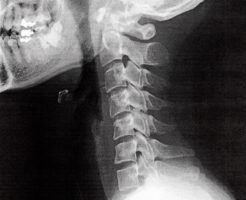 頚椎　ストレートネック　x-p